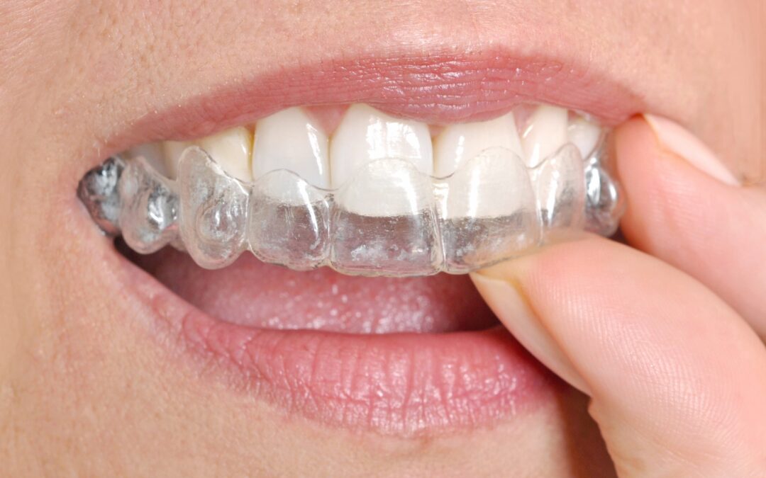 Broma Intervenir Pisoteando 6 tips para que los retenedores dentales te duren más tiempo