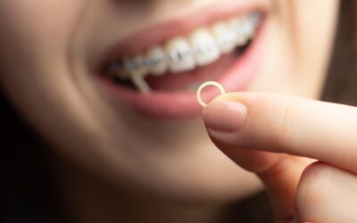 Invisalign: ¿para qué se utilizan las gomas en la ortodoncia invisible?