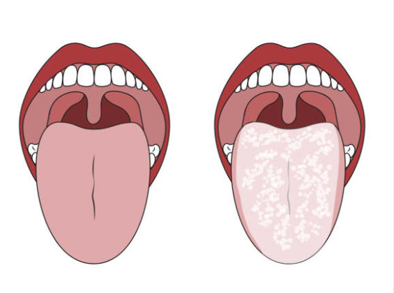 ¿Tienes hongos en la boca? Síntomas y soluciones