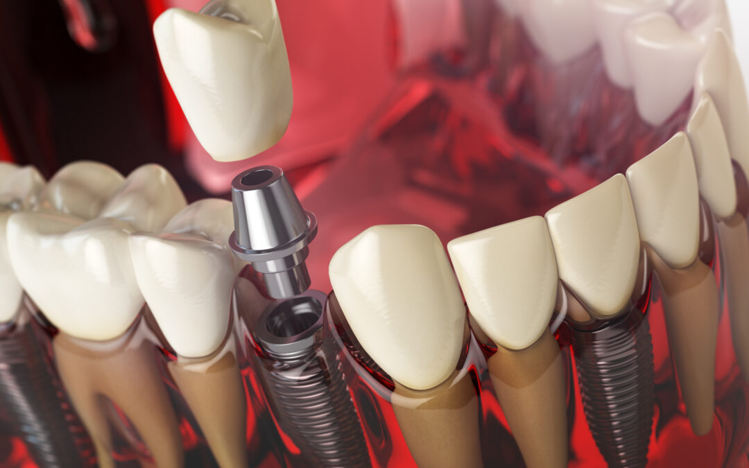 Implantes o puentes dentales: estas son sus diferencias