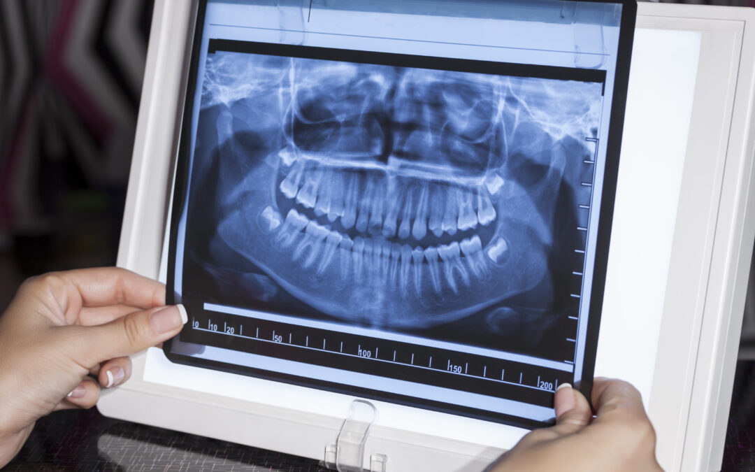 ¿Qué es el taurodontismo y qué supone para los dientes?