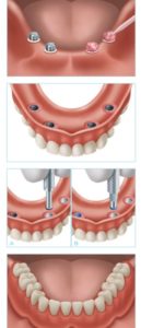 Rehabilitación completa mediante implantes