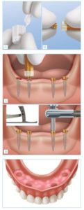 Rehabilitación completa mediante implantes