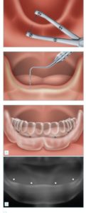 Rehabilitación completa mediante implantes