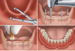 Rehabilitación completa mediante implantes