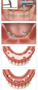 Rehabilitación completa mediante implantes