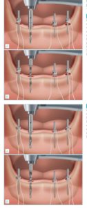 Rehabilitación completa mediante implantes