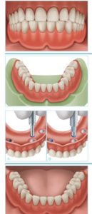 Rehabilitación completa mediante implantes