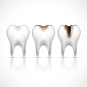 diente caries