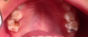 ejemplos de caries infantil