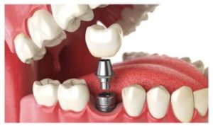 implantes dentales