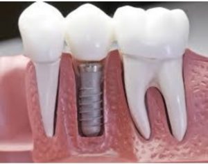 implantes dentales