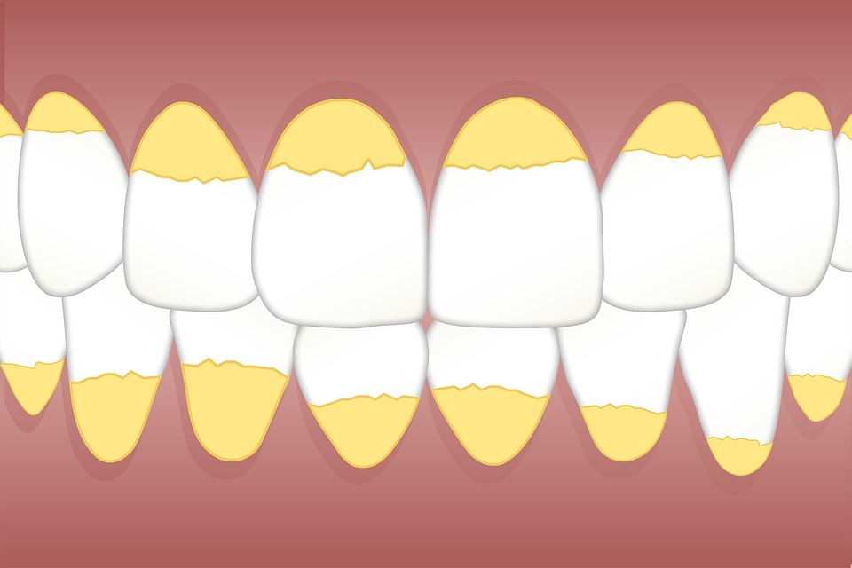 Sarro dental: Por qué se forma y cómo eliminarlo