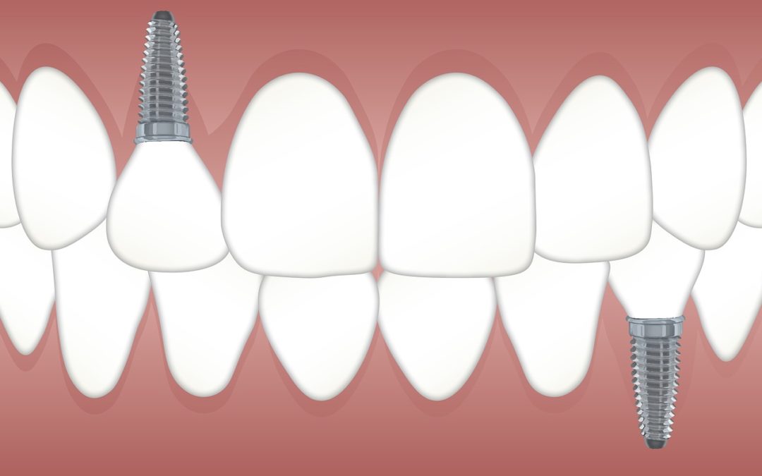 Implantes dentales: ¿qué cuidados debo seguir?