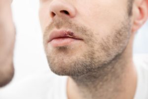 Las 5 infecciones bucales más frecuentes