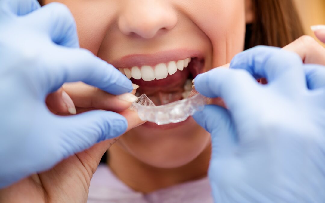 Sigue estos consejos para limpiar tu Invisalign