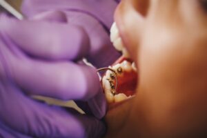 brackets-linguales-clinica-dental