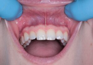 sangrado-encias-dentista