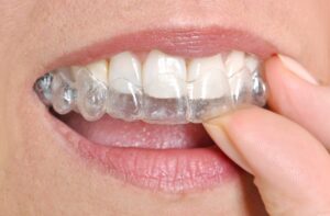 retenedores-invisalign-ortodoncia-invisible
