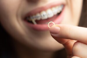 gomas-ortodoncia-invisible-invisalign