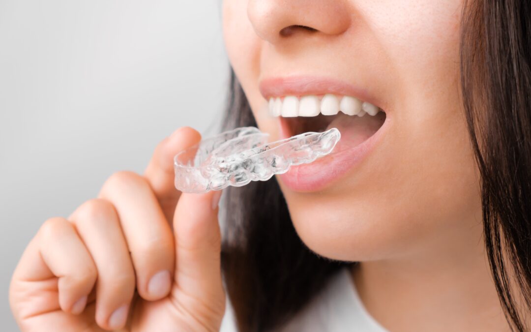 Invisalign: para qué sirven los ataches en la ortodoncia invisible