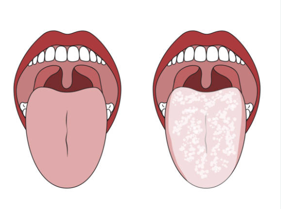 Síntomas de la candidiasis - Halitosis