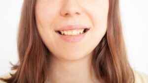 sonrisa-gingival-encias-soluciones