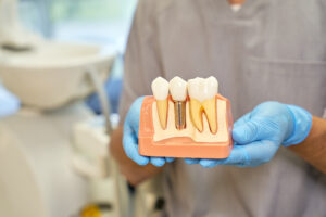 como-cuidar-implantes-dentales