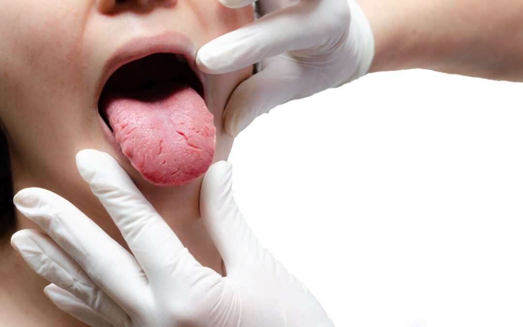 ¿Qué es la lengua vellosa y cómo tratarla?