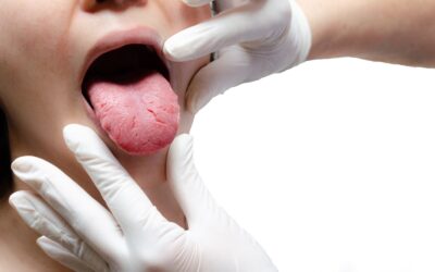 ¿Qué es la lengua vellosa y cómo tratarla?