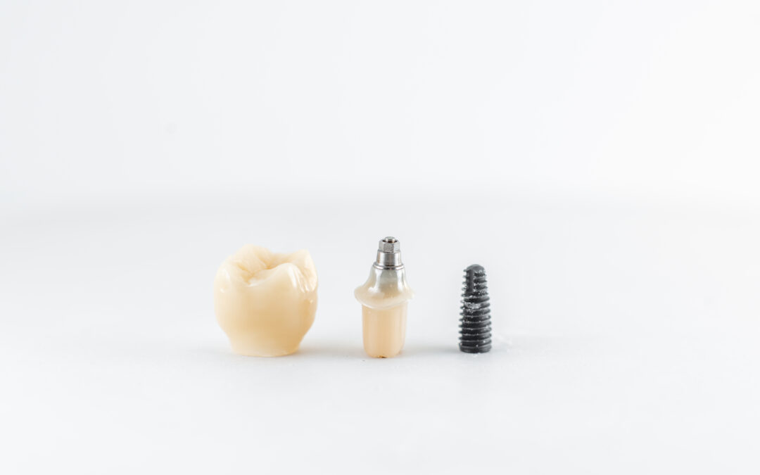¿Qué son los implantes dentales y quién es candidato a este tratamiento?